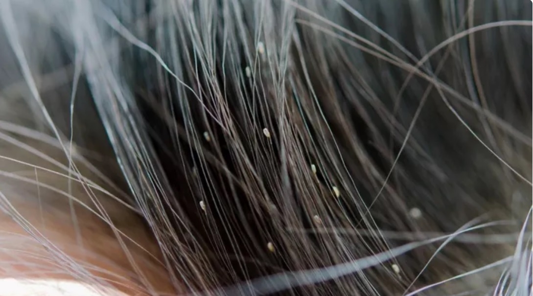 Bahan Alami untuk Mengurangi Kutu di Rambut, Dijamin Kutu Berkurang!