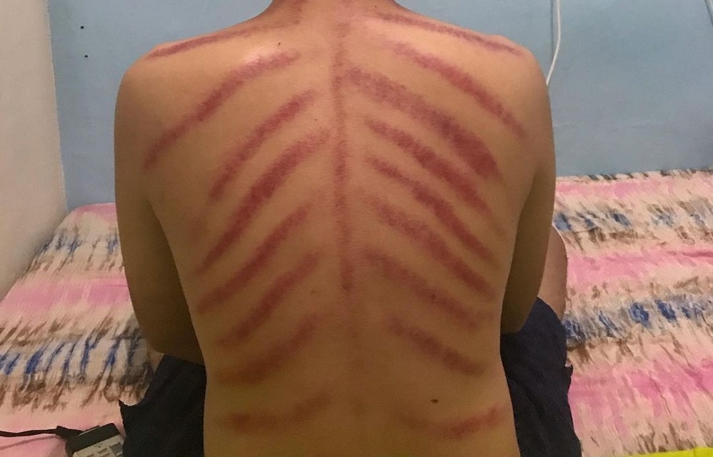 Catat! Ini 5 Bahaya dari Kebiasaan Dikerok saat Masuk Angin