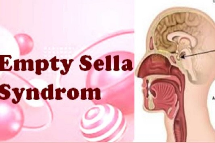 Apa Itu Empty Sella Syndrome, Penyakit Langka yang Sebabkan Disfungsi Ereksi pada Pria?