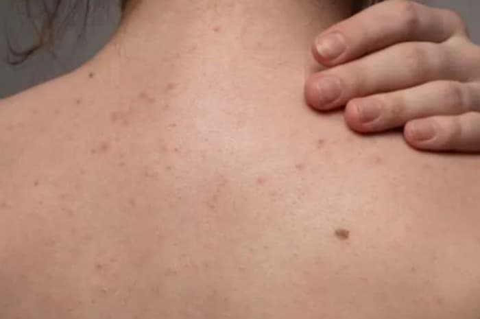 Jerawat di Punggung Bikin Nggak Nyaman? Inilah 5 Penyebab Umum yang Sebaiknya Dihindari