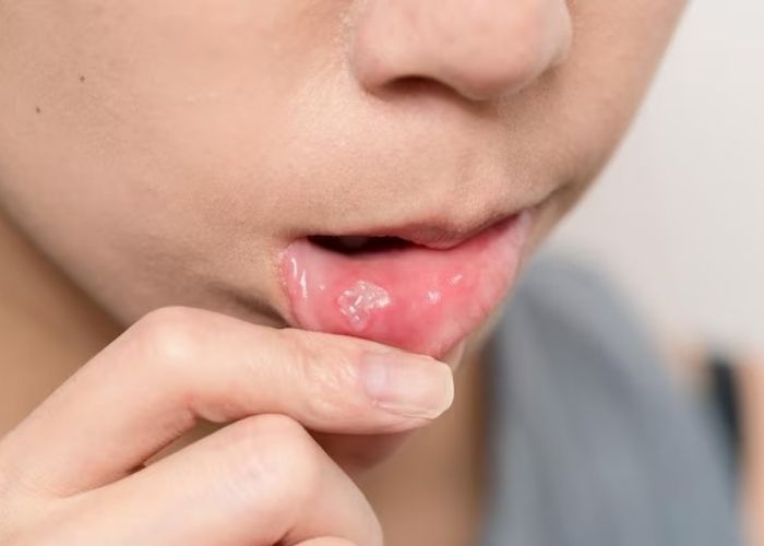 8 Makanan Ampuh Pereda Nyeri Sariawan yang Wajib Kamu Coba