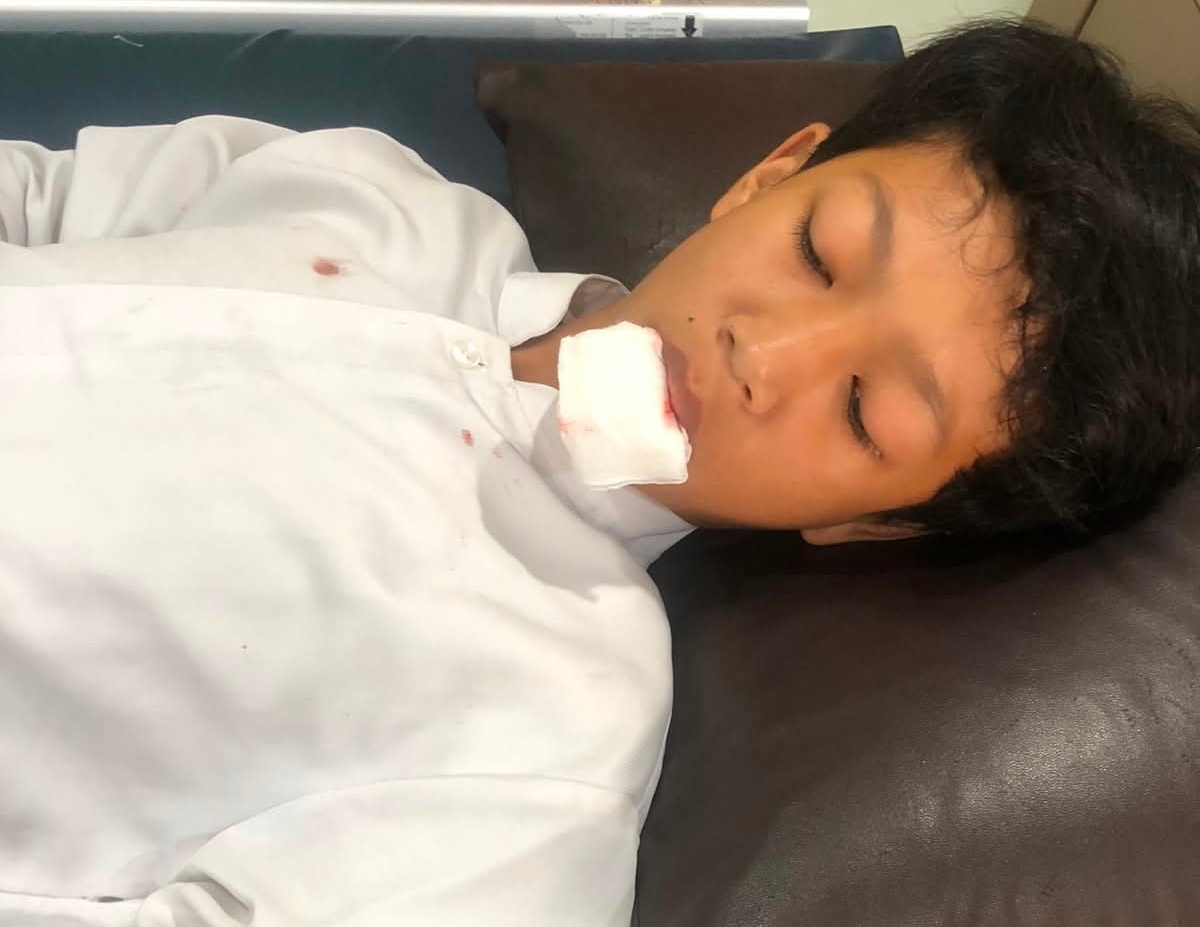 Kehilangan Gigi Permanen dan Bibir Sobek, Siswa SDIT Salsabila Bekasi Korban Tabrak Motor Alami Trauma, Keluarga Tuntut Keadilan