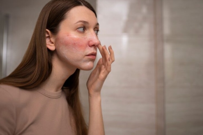 Jerawat Muncul Setelah Ganti Skincare, Jangan Langsung Anggap Purging