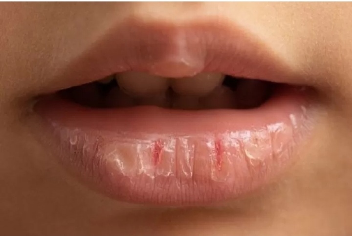 Mudah Didapat dan Minim Efek Samping, Ini 4 Bahan Rumahan untuk Mencegah dan Mengobati Bibir Pecah-pecah