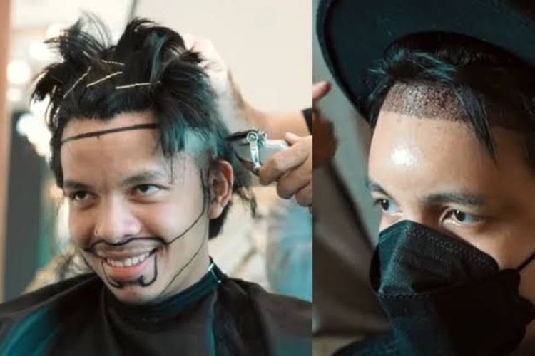 5 Seleb Ini Atasi Kebotakan dengan Gelontorkan Uang Puluhan Juta untuk Transplantasi Rambut
