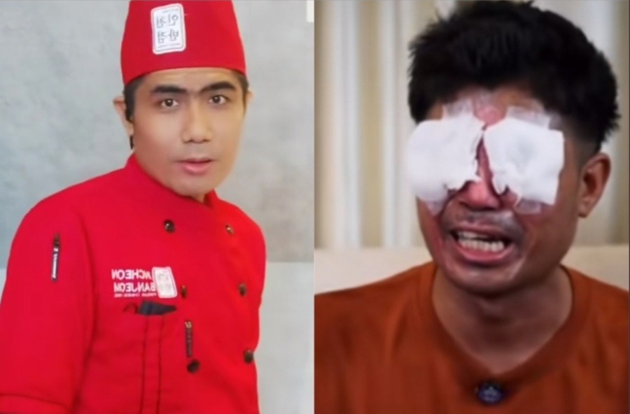 6 Tindakan Pertama Ketika Tersiram Air Keras, Cegah Kerusakan Lebih Lanjut pada Kulit dan Jaringan