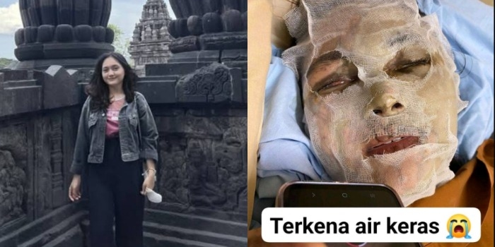 Viral! Tak Mau Diajak Balikan, Mahasiswa di Jogja Natasya Hutagalung Disiram Air Keras Oleh Mantan Pacarnya hingga Terancam Buta