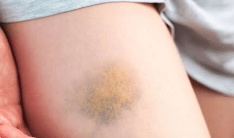 Mudah Muncul Memar, Waspadai Gejala Trombositopenia yang Sering Tak Disadari